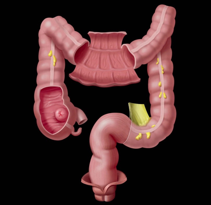 Đại trực tràng (Large bowel)