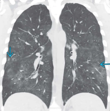 HIV/AIDS (Biểu hiện ở phổi và lồng ngực) - HIV/AIDS (pulmonary and thoracic manifestations)