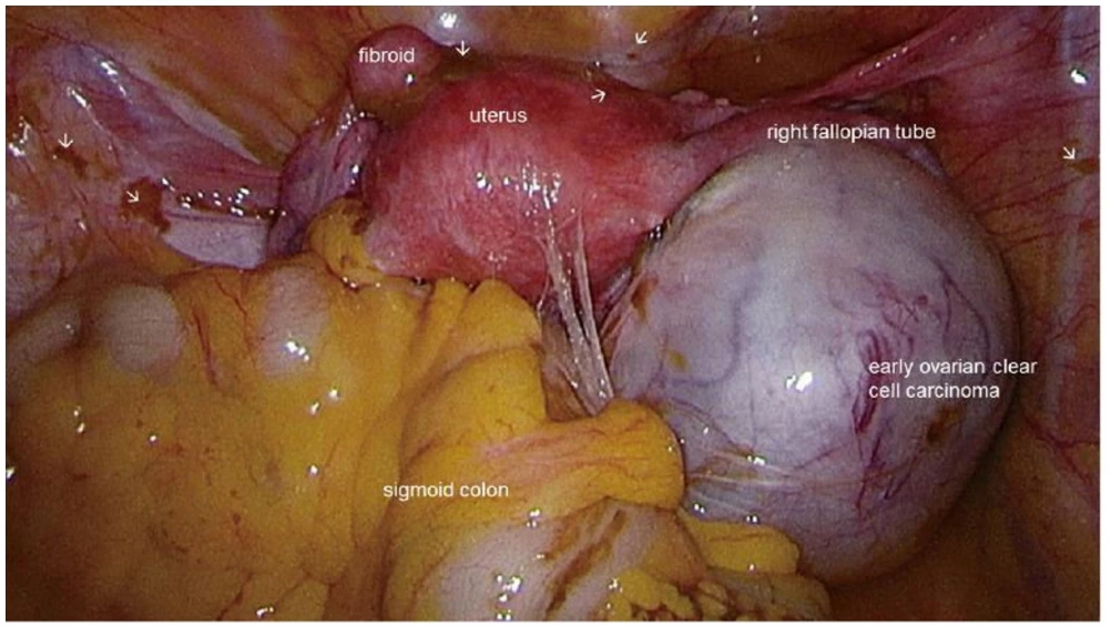 Ung thư biểu mô tế bào sáng của buồng trứng (Ovarian clear cell carcinoma)