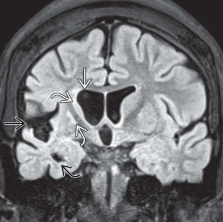 Viêm não Rasmussen (Rasmussen encephalitis)