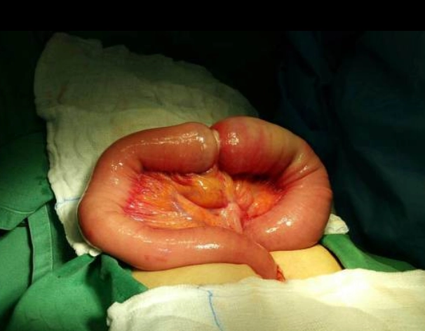 Ung thư biểu mô tuyến ruột non (Adenocarcinoma of the small bowel)