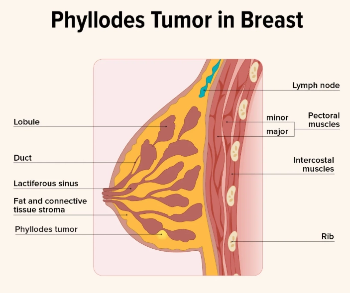 U diệp thể (Phyllodes tumors)