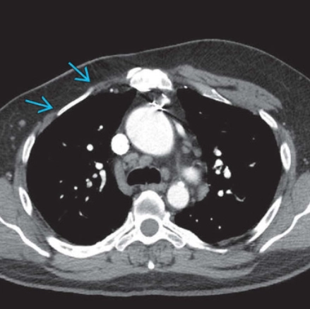 Hội chứng Poland (Poland Syndrome)/ Hội chứng bất sản cơ ngực-dính ngón (Pectoral aplasia-syndactyly syndrome)