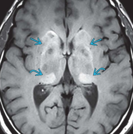Bệnh Fabry (Fabry Disease)