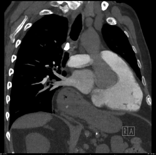 Dấu hiệu xóa bờ (Silhouette Sign)