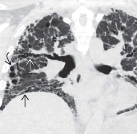 Giãn phế quản do co kéo (Traction Bronchiectasis)