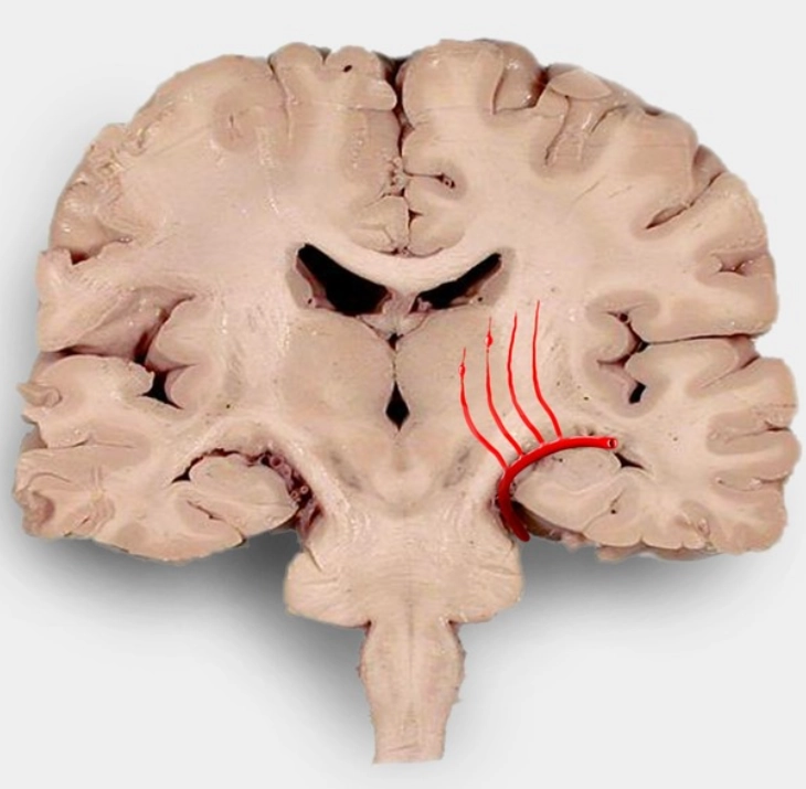 Xuất huyết não thất (Intraventricular Hemorrhage - IVH)