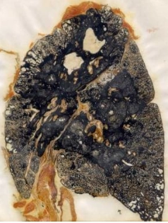 Bệnh bụi phổi Silic (Silicosis)/Bệnh bụi phổi công nhân mỏ than (Coal Worker's Pneumoconiosis - CWP)