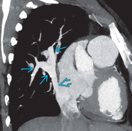 Hội chứng Scimitar (Scimitar Syndrome)/Hội chứng thiểu sản phổi (Hypogenetic lung syndrome)