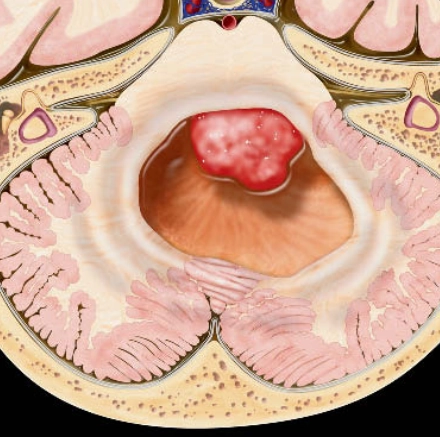 U sao bào lông (Pilocytic Astrocytoma)