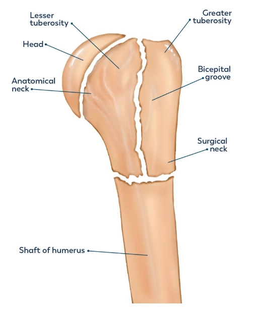 Gãy đầu trên xương cánh tay (Proximal humeral fracture)
