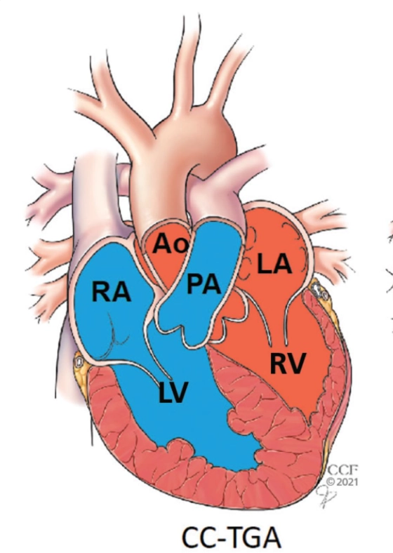 Hoán vị đại động mạch có sửa chữa