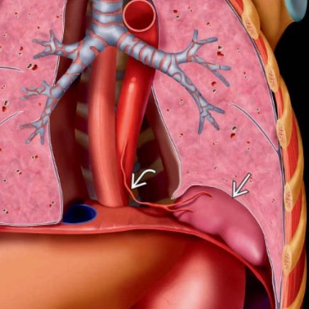 Phổi biệt trí ngoại thùy - Pulmonary sequestration (extralobar)