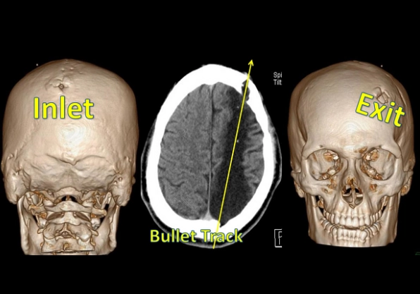Chấn thương sọ não xuyên thấu do vật tốc độ cao (High-velocity penetrating brain injury)