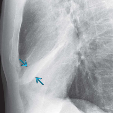 Hội chứng thùy giữa phải (Right middle lobe syndrome)