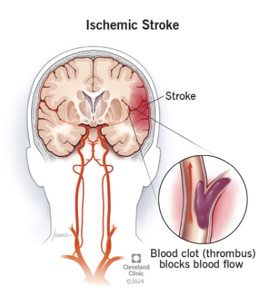 Nhồi máu não do thiếu máu cục bộ (Ischemic stroke)