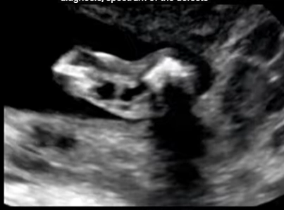 Bất thường cốt hóa thai (Abnormal Ossification)