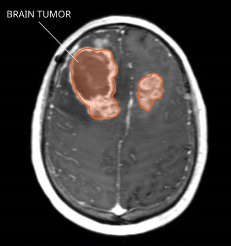 U thần kinh đệm ác tính (Gliosarcoma)