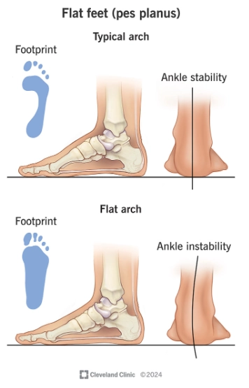 Bàn chân bẹt (Pes planus)