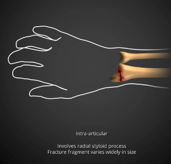 Gãy Chauffeur (Chauffeur fracture)