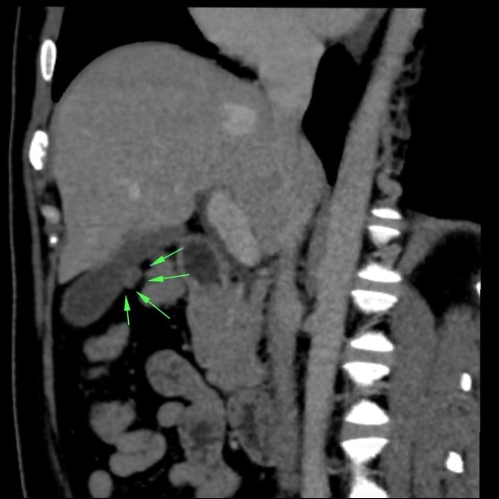 Túi thừa túi mật (Gallbladder Diverticula)