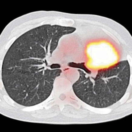 Dấu hiệu Luftsichel (Luftsichel sign)