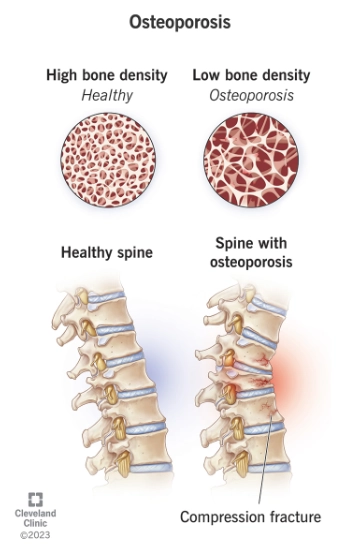Loãng xương (Osteoporosis)