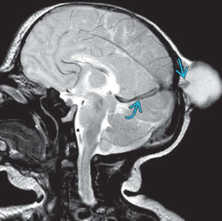 Cephalocele (Thoát vị não-màng não)