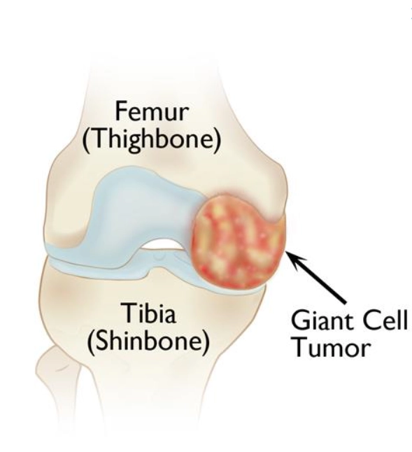 U tế bào khổng lồ của xương (Giant Cell Tumor - GCT of bone)