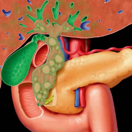 Viêm gan mật mủ tái phát (Recurrent pyogenic cholangiohepatitis)