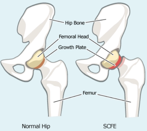 Trượt chỏm xương đùi (Slipped upper femoral epiphysis)