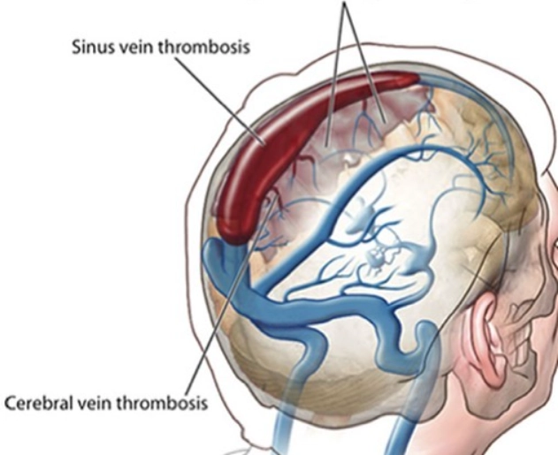 Dị dạng xoang tĩnh mạch màng cứng (Dural Sinus Malformation - DSM)
