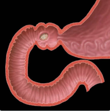 Loét tá tràng (Duodenal Ulcer)