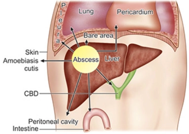Áp xe gan do amip (Amoebic hepatic abscess)