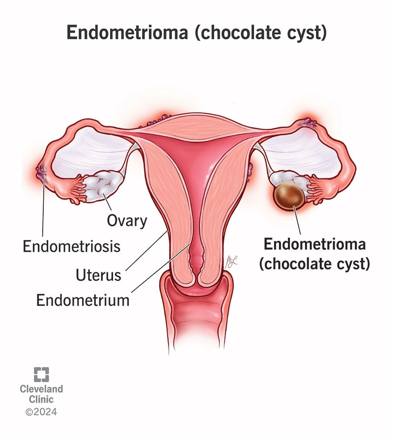 Nang lạc nội mạc tử cung (Endometrioma)