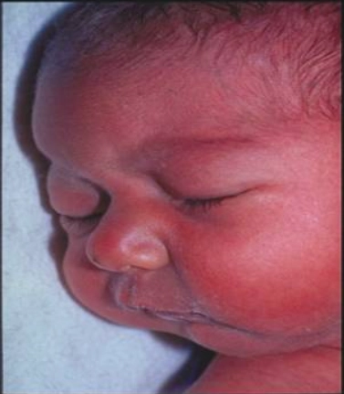 Cằm nhỏ (Micrognathia)