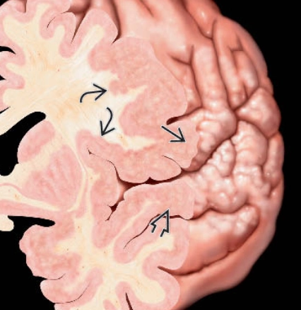 Đa hồi não nhỏ (Polymicrogyria)