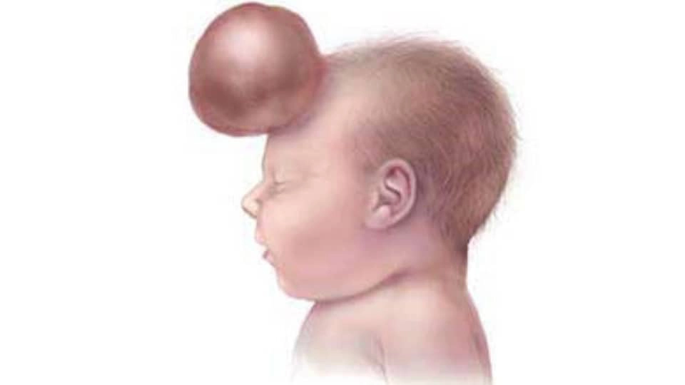 Frontal cephalocele