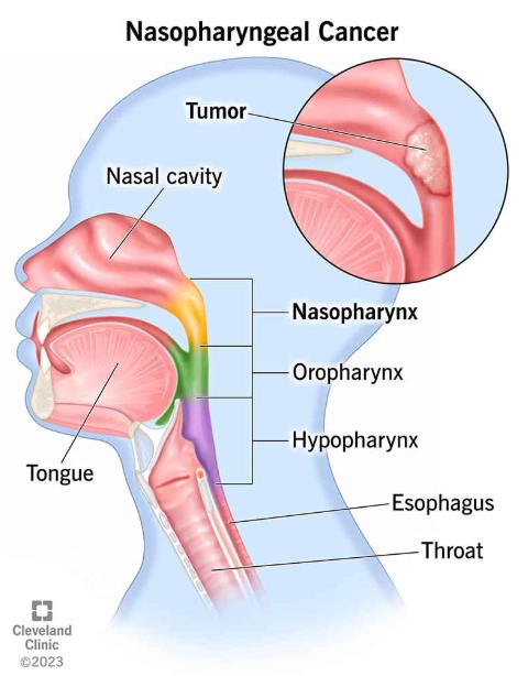 Phân giai đoạn Ung thư vòm họng (Nasopharyngeal cancer (staging))