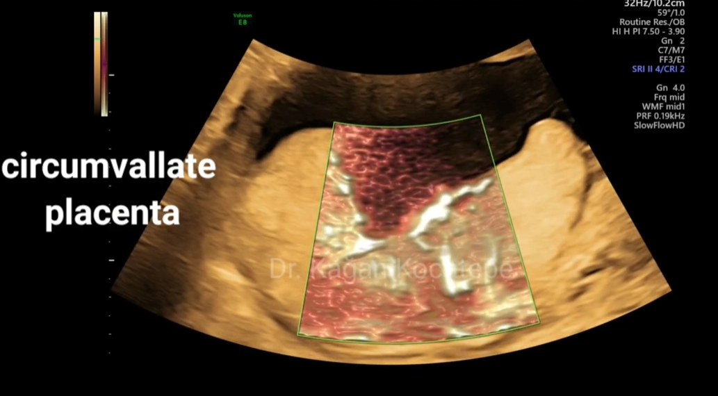 Nhau cuộn mép (Circumvallate Placenta)