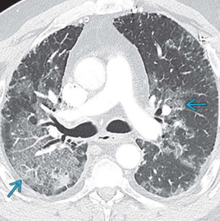 Tắc mạch phổi do mỡ (Pulmonary Fat Embolism)/Thuyên tắc mỡ (Fat Embolism - FE)