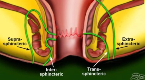 Rò hậu môn (Perianal fistula)