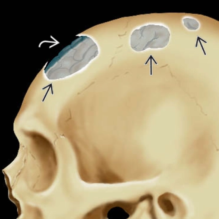 Bệnh mô bào Langerhans (biểu hiện ở hệ thần kinh trung ương) - Langerhans cell histiocytosis (CNS manifestations)