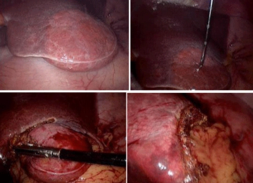 Gan nhiễm mỡ khu trú (Focal hepatic steatosis)
