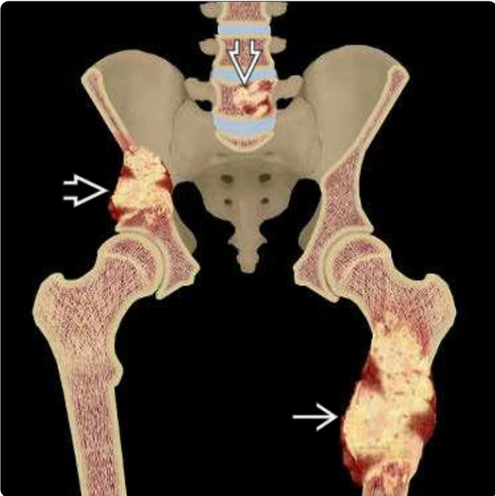 Các loại u xương (Bone tumors)