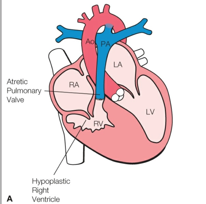 Tắc nghẽn van động mạch phổi với vách liên thất nguyên vẹn (PA-IVS)