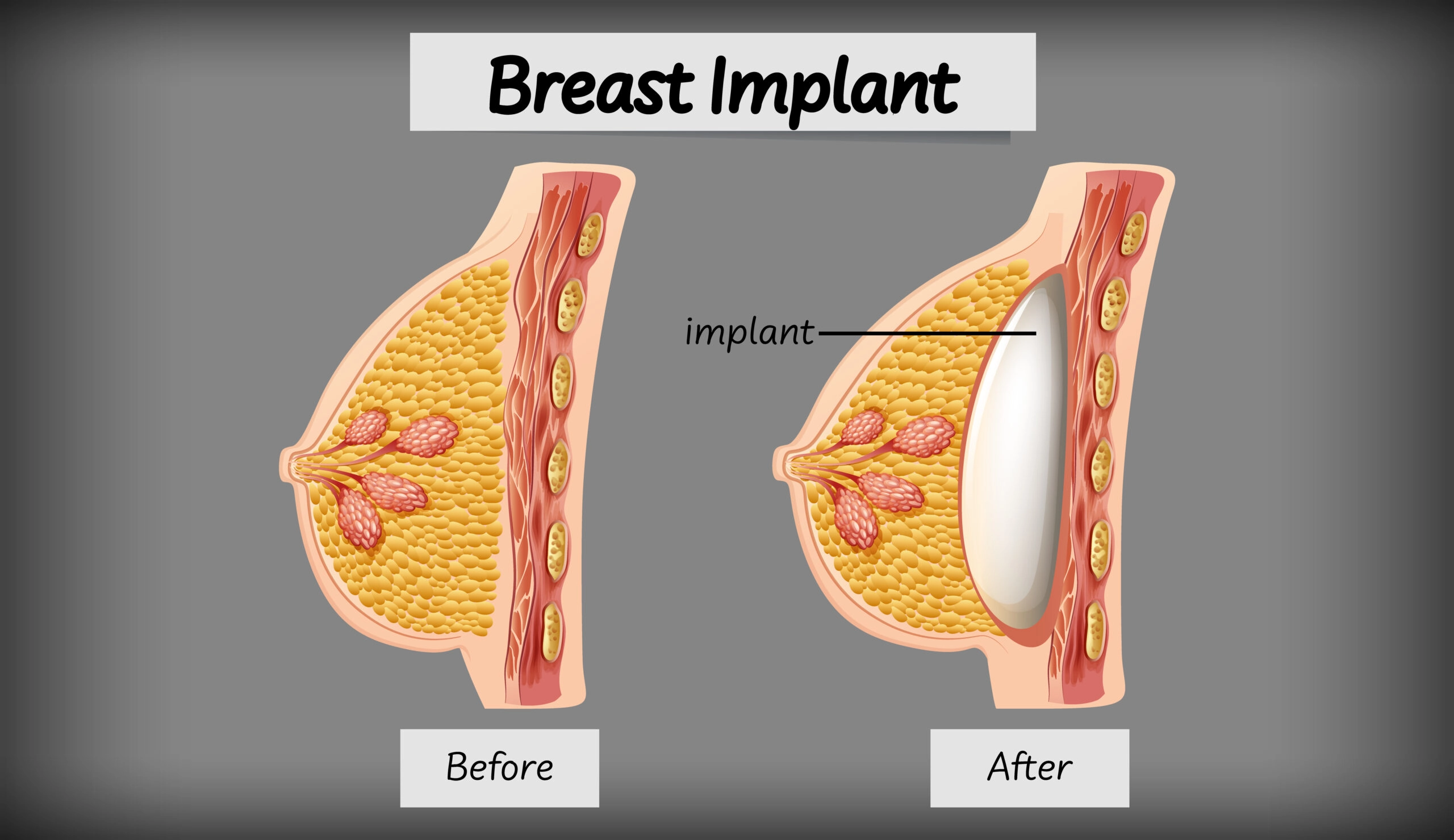 Túi ngực (Breast implants)