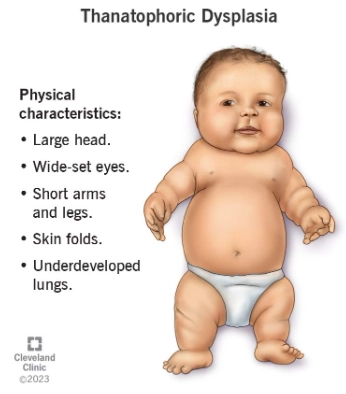 Loạn sản xương gây chết (Thanatophoric Dysplasia)