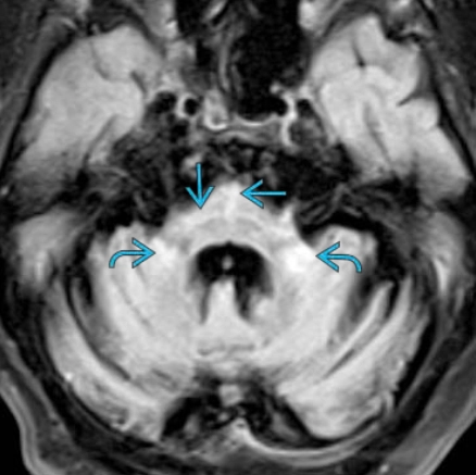 Mất điều hòa tủy sống- tiểu não (Spinocerebellar Ataxia - SCAs)