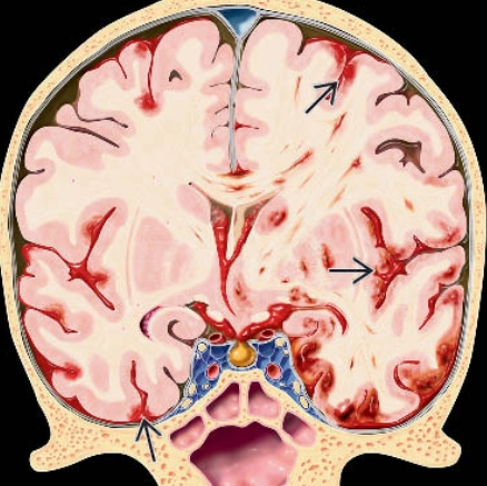 Xuất huyết dưới nhện do chấn thương (Traumatic Subarachnoid Hemorrhage - tSAH)